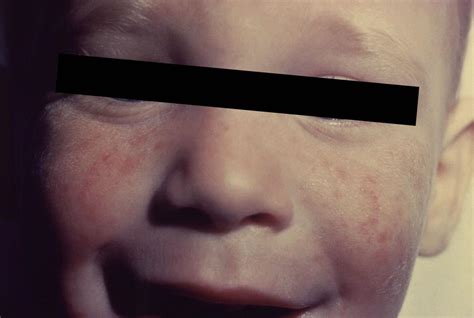 bacterial meningitis red macular rash